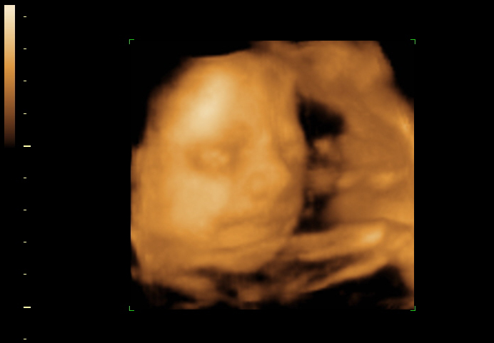 3D ultrasound image at 26 weeks